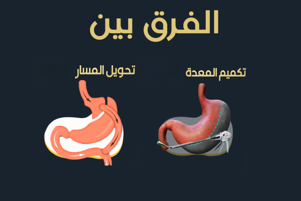 الفرق بين تكميم المعدة وتحويل المسار