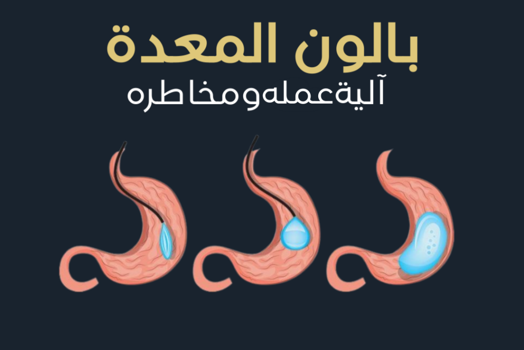 هل بالون المعدة آمن لعلاج السمنة؟